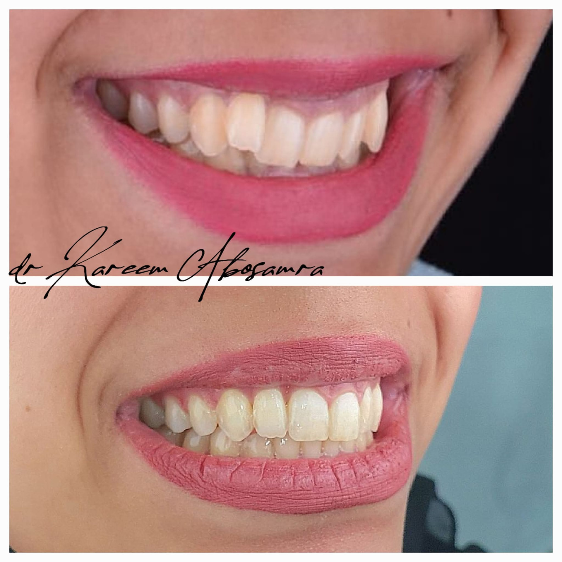 Case 1 — Smile line & alignment (Before / After)