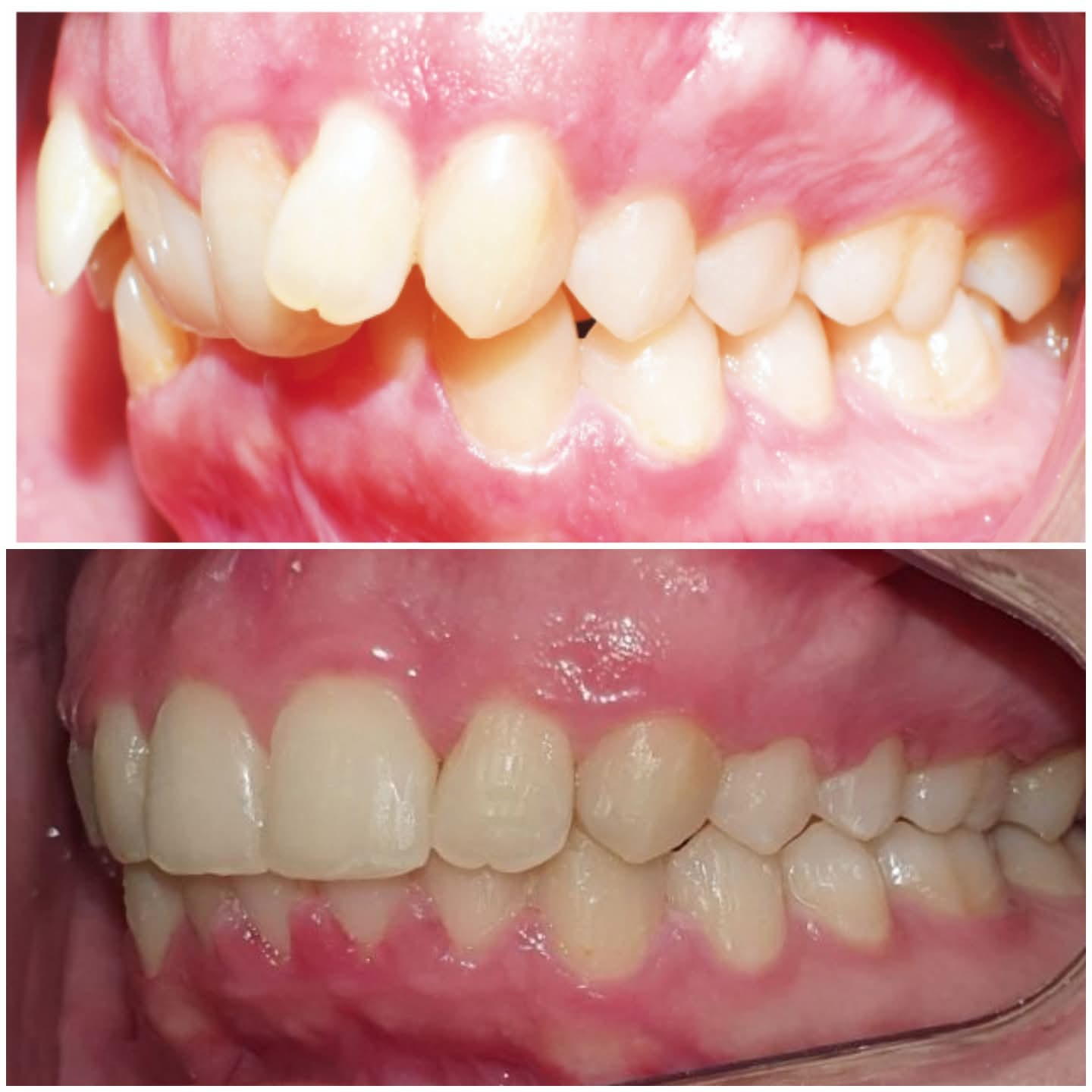 Case 2 — Crowding & bite correction (Before / After)