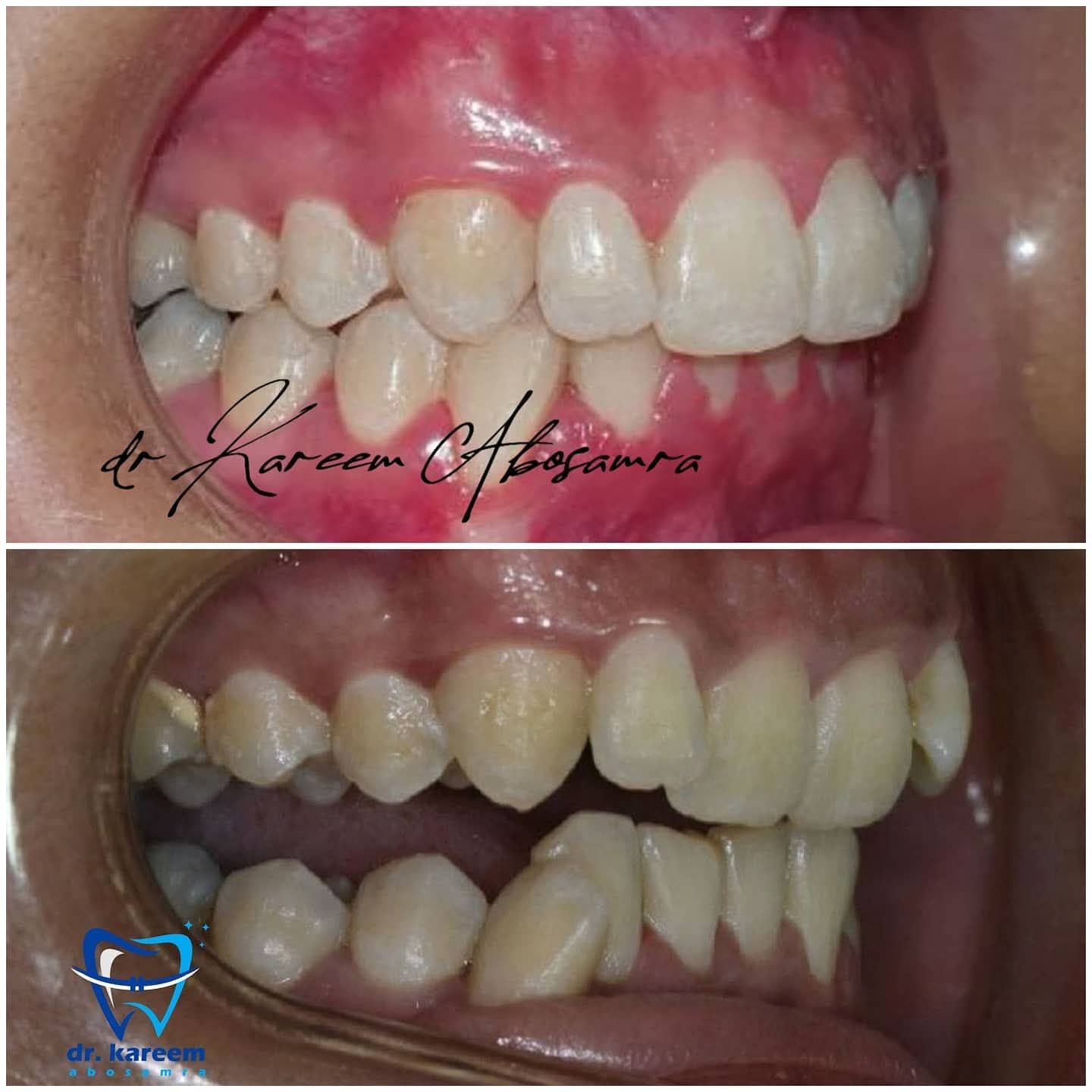 Case 3 — Crossbite & spacing (Before / After)